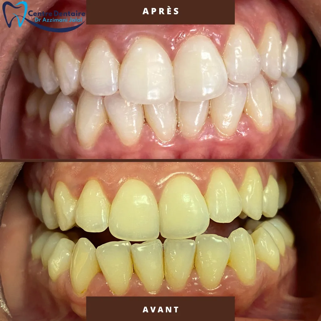 blanchiment des dents avant après